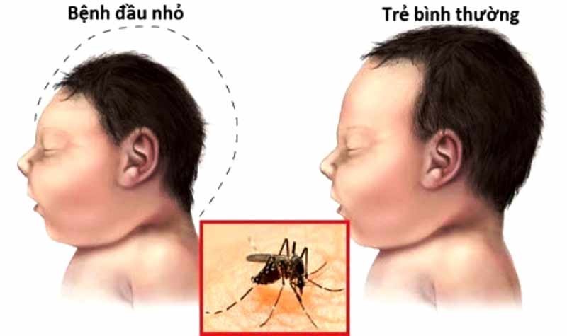 Zika virus causes microcephaly in newly born babies Zika virus causes microcephaly in newly born babies